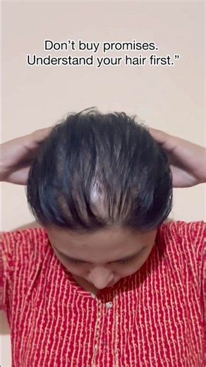 Hair Loss Reality Nobody Talks About 💔Stop Believing Every Hair Growth Before-After! #hairthinning