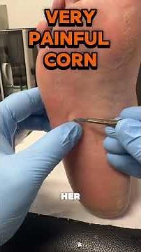 Very painful deep corn removal in the podiatry clinic ergonx.com.au