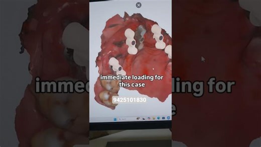 Horizontal Scan Bodies. For Immediate loading cases where bleeding creates… | Dr Rohit Agrawal