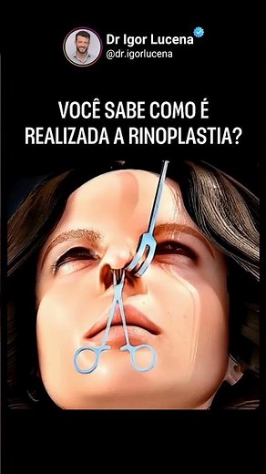 Você sabe como é feita uma rinoplastia? 👃🏻✨ #drigorlucena #consultaonline #rinoplastiabahia
