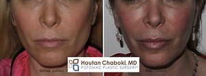 How Can BOTOX Reduce a Square Jawline? – Potomac Plastic Surgery
