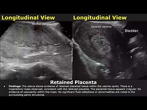 Postpartum Uterus Ultrasound Reporting | RPOC/Retained Placenta Scan Reports | Pelvic USG