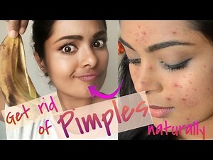 How To Get Rid Of Pimples OVERNIGHT!(Really Works) Treat Acne At Home Naturally - Cheap DIY Skincare
