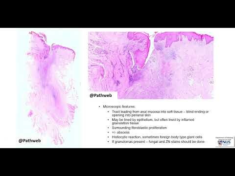 Anal canal: Fistula-in-ano - Virtual microscopy (Talking slide)