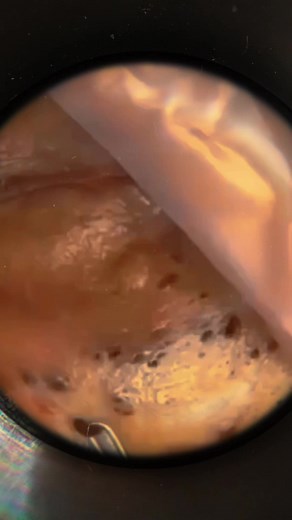 Pimple extraction black dot fish-eye #pimple #pimplepop #fisheye #pimplepopper