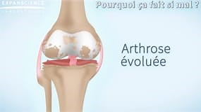 L'arthrose du genou