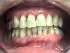 AIR-N-GO Perio Easy Clinical Video