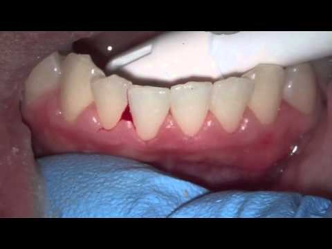 evaluating bleed gums