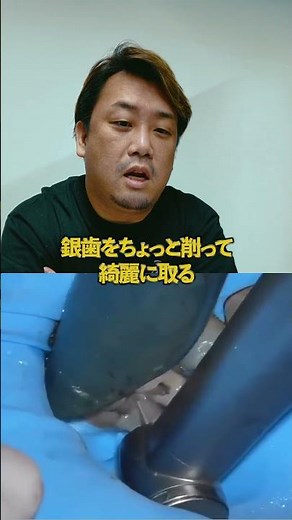 A dentist explains the procedure for removing silver fillings and inlays!