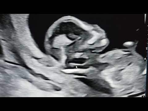 Open neural tube defect signs teaching in 12 week fetus.Dr Pradeep.REFER .