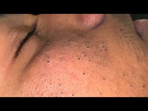 Satisfying Blackhead And Pimple Removal