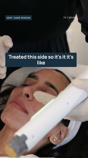 XERF before and after: halfway through skin tightening treatment