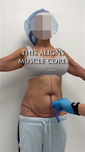 Following up on this patient we shared earlier this week #maxtuck #awaketummytuck #tummytuckresults