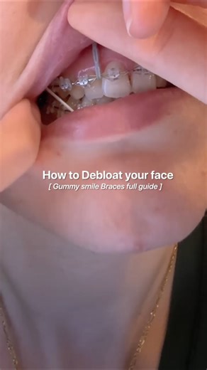 How to Debloat your face | Gummy smile braces full guide