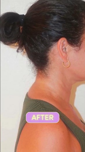 ay Goodbye to the "Buffalo Hump" | Dorsal Cervical Fat Pad Removal Before & After