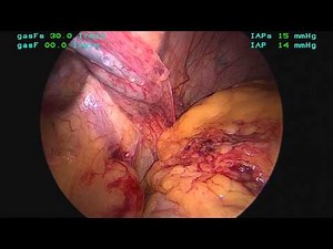 Agenesis Of The Left Hemidiaphragm:  A Case Report • Video • MEDtube.net
