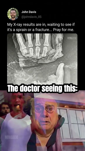 Hand X-ray results 💀