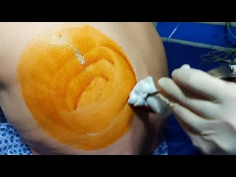 How to Remove 780cc Lung Fluid – Thoracentesis in Lung #healtheducation