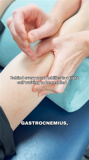 Orchard Health Clinic on Instagram: "Dry Needling for Achilles Tendinopathy 🪡🦶🏻 If you’ve been dealing with nagging pain around your heel or the back of your ankle — especially during running, jumping, or even your morning steps — you might be experiencing Achilles Tendinopathy. This condition happens when the Achilles tendon, which connects your calf muscles to your heel bone, becomes irritated or overloaded over time. One effective way to support recovery? 💥 Dry Needling Therapy. 🪡 How it