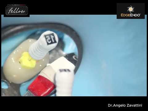 Root canal treatment of an UR5 using UTOPIA file system from EDGE Endodontics