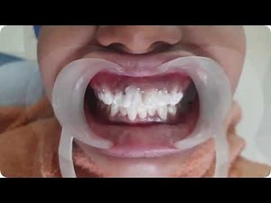 Treatment of Teeth Discoloration & Spots Using Tooth Mousse