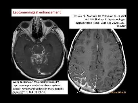 30. Meningeal enhancement; pachymeninges, leptomeninges, subarachnoid lymphatic like membrane (SLYM)