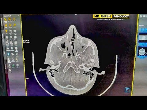 paranasal Sinus (PNS) CT Scan | Radiology Case | Mr. Akash Radiology | #medicalimaging #video