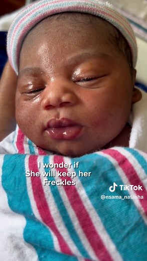 10-Month-Old Baby with Unique Skin Pigmentation | Celebrities with NF1