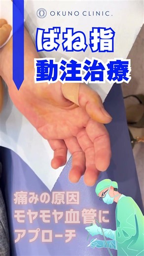 曲げ伸ばしで指が痛む「ばね指」に動注治療｜実際の治療風景