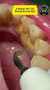 Sebaiknya buat rawatan Scaling Gigi setiap 6 bulan...#scaling #scalingteeth🦷 #scalinggigi #dentistmalaysia #klinikgiginearme | Klinik Pergigian Erfa