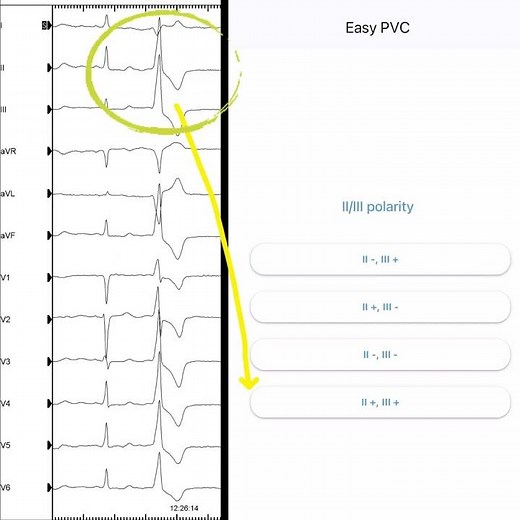 Tutorial of Easy-ECG App