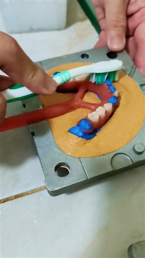 Suitability in the Philippines Context In the Philippines, “flexible dentures” (which include brands like Flexite) are increasingly available. One article estimates for 2025, flexible partial dentures cost around ₱15,_00-₱4_,000 depending on missing teeth and materials. If you’re located in Manila (as your location suggests), ask local labs/dental clinics if they are familiar with Flexite systems, check for local technicians experienced in thermoplastic/injection-moulded flexible dentures. Becau