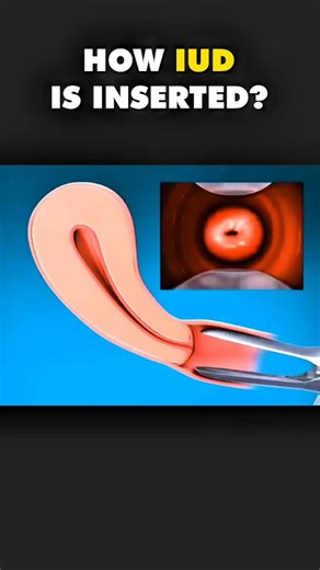 MEDICAL ANIMATION on Instagram: "How is an Intrauterine Device (IUD) inserted? In this 3D animation, you’ll see a simple step‑by‑step visualization of the IUD insertion process, including: pelvic exam and speculum placement cleaning the cervix measuring the uterus (sound) inserting the IUD through the cervix into the uterus trimming the strings for follow‑up checks This video is for education and visualization only — not medical advice. Only a qualified healthcare professional should insert or r