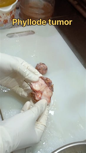 phyllode tumor from breast|#histopathology #tissuefixation #breastcancer #breastcancerawareness #lab