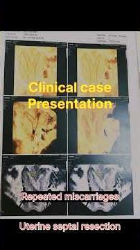 Hysteroscopy for Uterine septal resection in patients with recurrent missed abortions