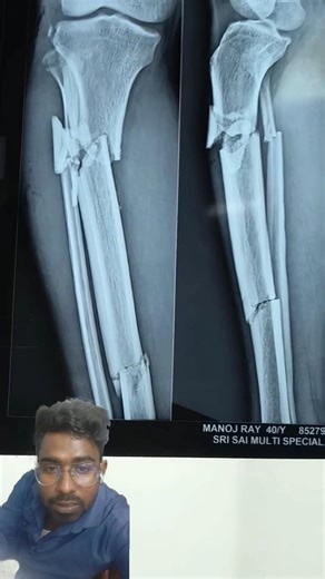 Ortho OT teble ready #medical #shorts