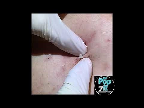 Clogged pore. Big Squeeze. Juicy pop. Cyst squeeze. MrPopZit.