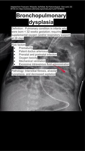 Bronchopulmonary dysplasia