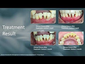 Chronic Periodontitis Management In Medical Compromised Patient : A Case Report