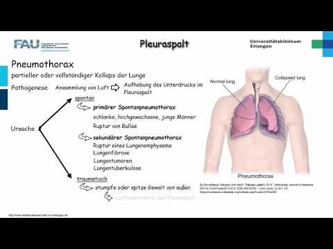 Chirurgie ─ Pleuraspalt Teil 2/2