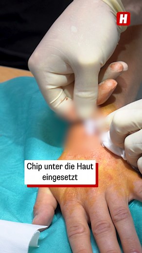 Einen Chip unter die Haut - unangenehm oder die Zukunft der Technologie? 🤔 #chip #implantieren #technologie | Heute