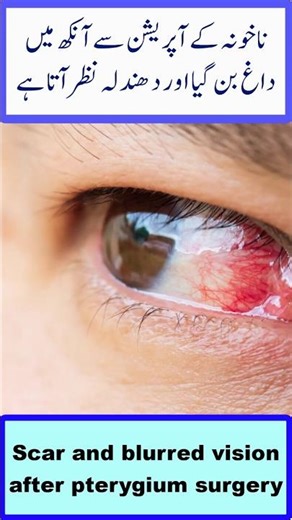 Scar and blurred vision after pterygium surgery (in Urd/Hindi)