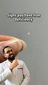 Signs you have Iron Deficiency 😱#IronDeficiency #LowIron | Dr Ankur Gautam