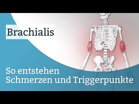 Brachialis Schmerzen, Triggerpunkte und deren Aktivierung