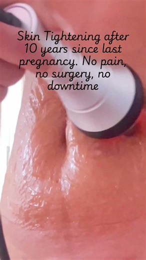 Radio Frequency Skin Tightening