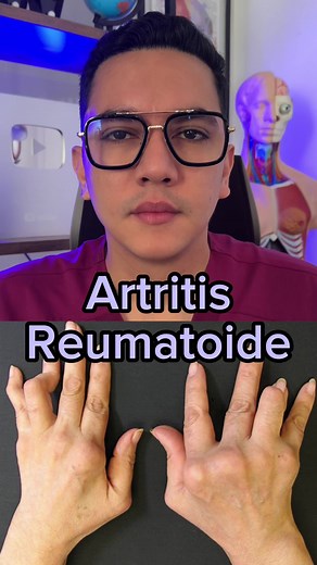 La artritis reumatoide y su riesgo de infarto cerebral