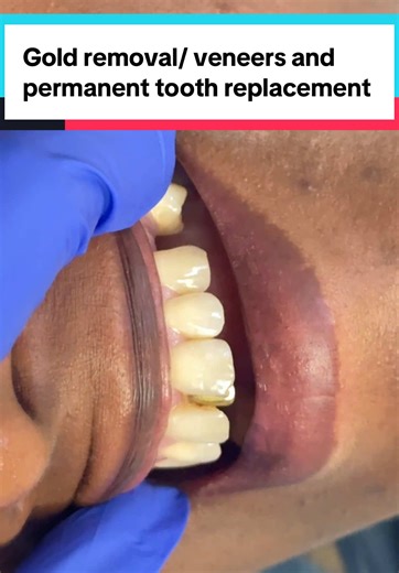 Transform Your Smile: Gold Tooth Removal and Veneers