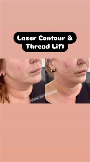 Flawless Laser on TikTok