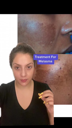 Melasma Treatment: A Complete Routine