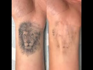 How To Remove Permanent Tattoo Naturally